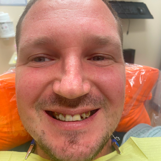 whitening before.